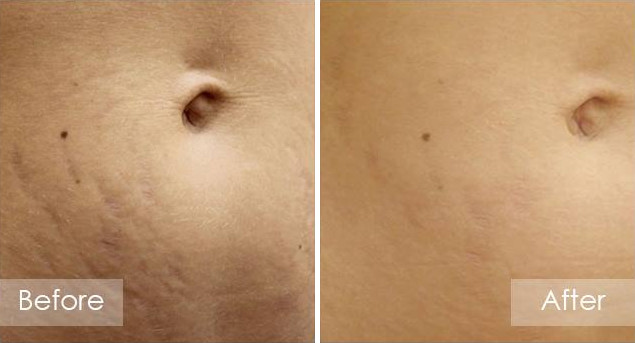 Stretch Marks Before and after